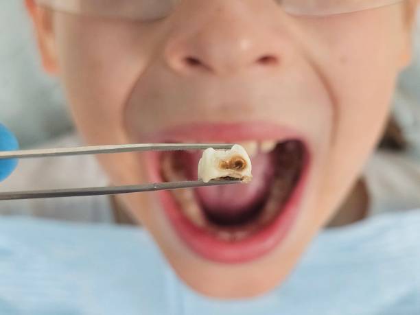 Best Emergency Tooth Extraction in University Center, VA